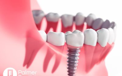 How Dental Implants Work: The Science Behind a Natural-Looking Smile