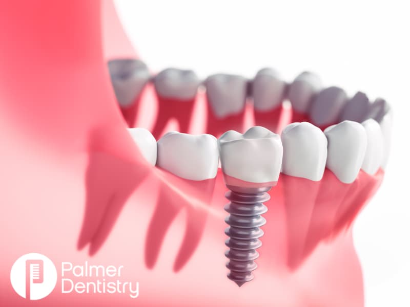 How Dental Implants Work: The Science Behind a Natural-Looking Smile