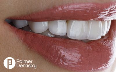 Achieve Your Dream Smile with Cosmetic Veneers at Palmer Dentistry