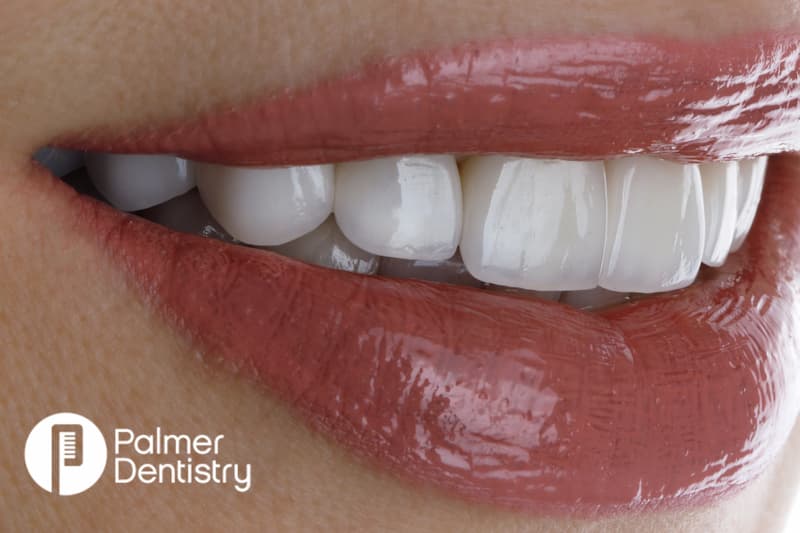 Achieve Your Dream Smile with Cosmetic Veneers at Palmer Dentistry