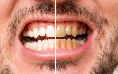 Why Professional Teeth Whitening Is Superior to DIY Methods